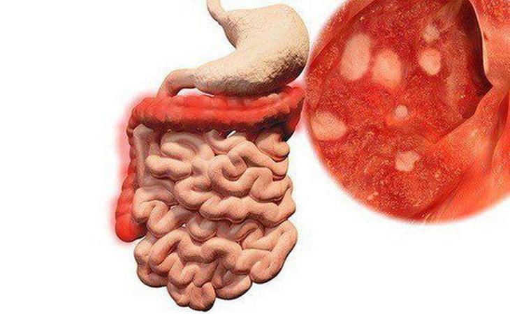 Viêm ruột có nguy hiểm không? - Ảnh 1.