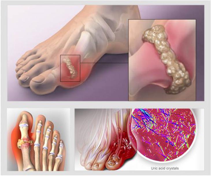 Tăng acid uric có làm suy giảm ‘bản lĩnh’ nam giới? - Ảnh 2.