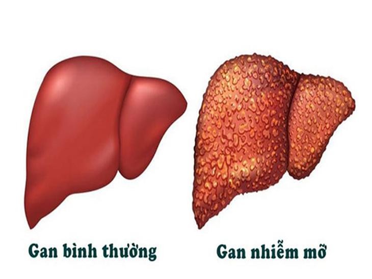 Các xét nghiệm cần làm để kiểm tra, đánh giá mức độ gan nhiễm mỡ- Ảnh 1.