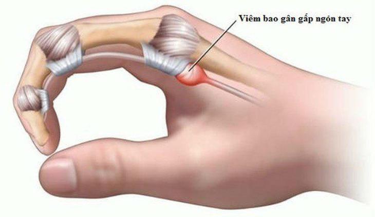 Ngón tay đau hoặc bật lò xo, cảnh giác với viêm gân gấp ngón tay- Ảnh 1.