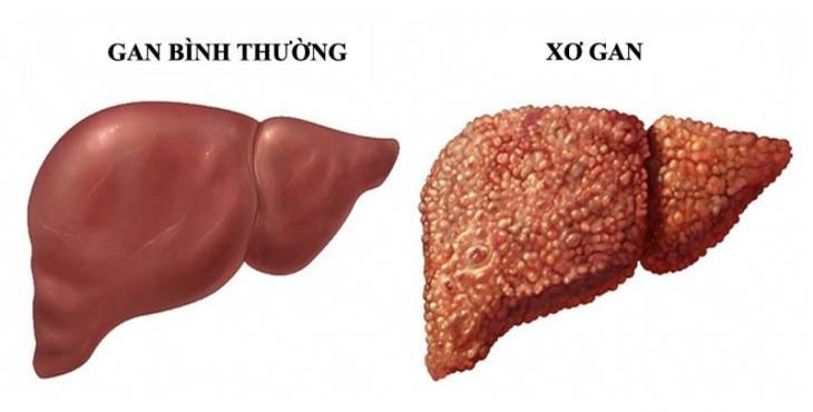 Xơ gan có dẫn đến ung thư gan? Hiểu biết đúng để phòng bệnh hiệu quả - Ảnh 2.