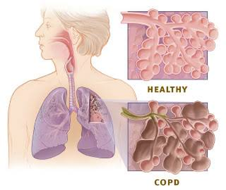 COPD - Không chỉ người hút thuốc mới mắc bệnh - Ảnh 2.