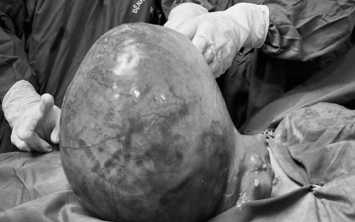Bụng to bất thường, người phụ nữ bất ngờ phát hiện khối u nặng 4 kg- Ảnh 3.