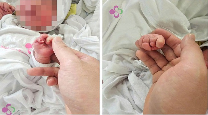 Giải cứu chi cho bé sơ sinh mắc hội chứng dải sợi ối hiếm gặp- Ảnh 1.