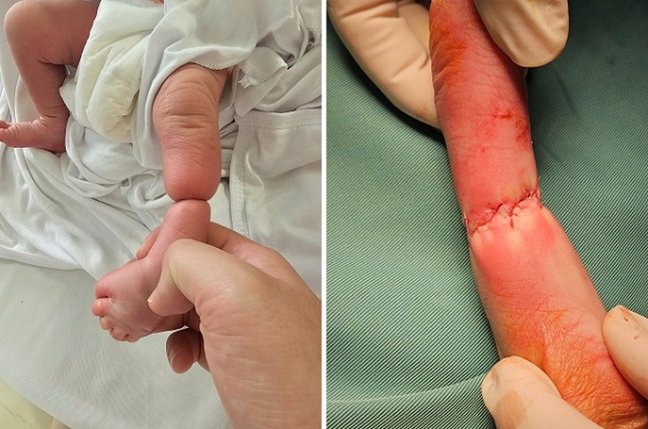 Giải cứu chi cho bé sơ sinh mắc hội chứng dải sợi ối hiếm gặp- Ảnh 2.