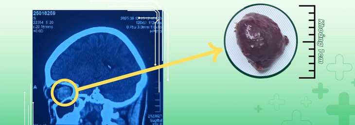 Mắt lồi, mất thị lực do khối u nằm sâu sau nhãn cầu- Ảnh 2.