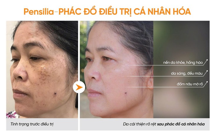Góc nhìn chuyên gia: Vì sao nám da dễ tái phát dù đã điều trị?- Ảnh 2.