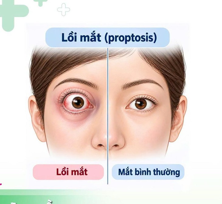 Mắt lồi, mất thị lực do khối u nằm sâu sau nhãn cầu- Ảnh 1.