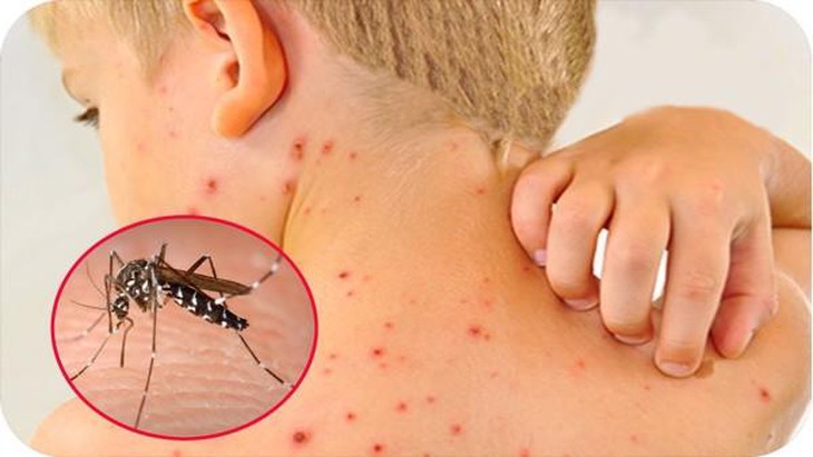 7 dấu hiệu cảnh báo sốt xuất huyết chuyển nặng sau khi hết sốt - Ảnh 1.