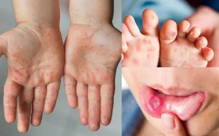 Dung dịch sát khuẩn tay chân miệng cho trẻ nào vừa an toàn, giá cả lại phải - Ảnh 6.