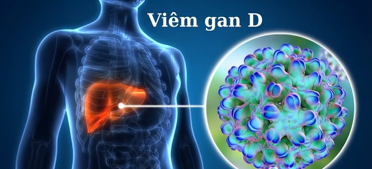 HIV và viêm gan D mạn tính: Vì sao cần đặc biệt lưu ý? - Ảnh 1.