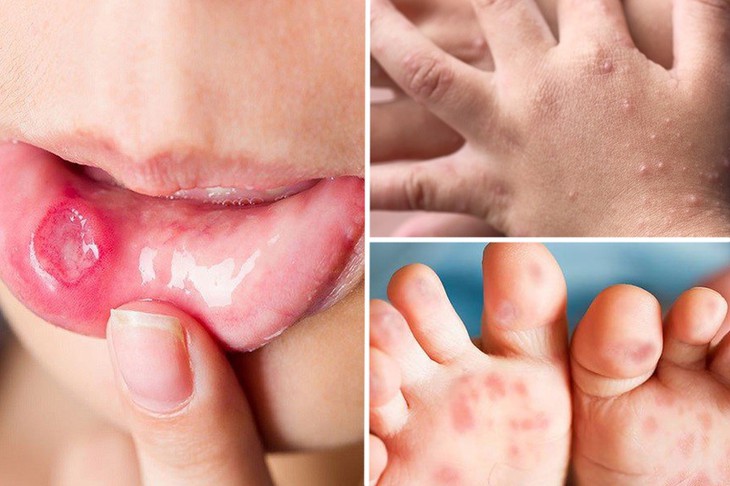 Dung dịch sát khuẩn tay chân miệng cho trẻ nào vừa an toàn, giá cả lại phải - Ảnh 3.