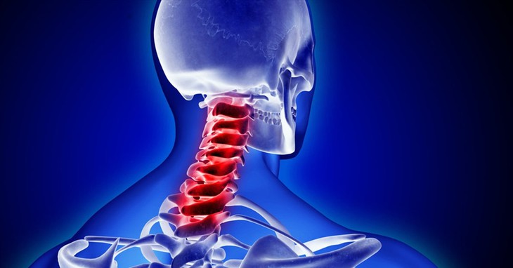 Ai cần thận trọng hoặc không nên tự ý kéo giãn cột sống cổ? - Ảnh 1.