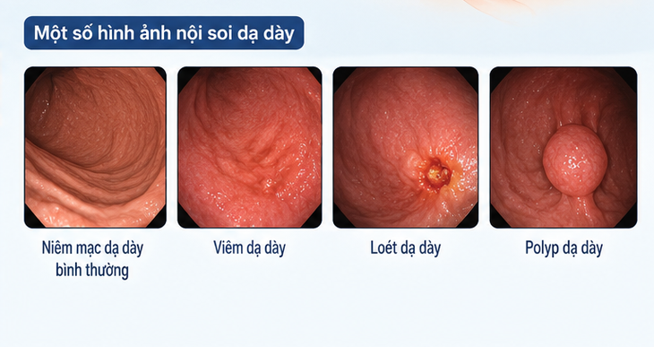 Không nên tự đi nội soi dạ dày, đại tràng- Ảnh 2.