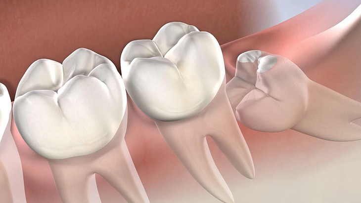 Răng số 8 mọc lệch có thể gây biến chứng gì?- Ảnh 1.