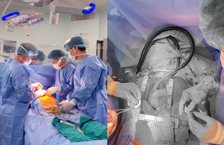 Cấy ghép thành công CorHeart 6: Thêm lựa chọn cho người suy tim nặng- Ảnh 1.