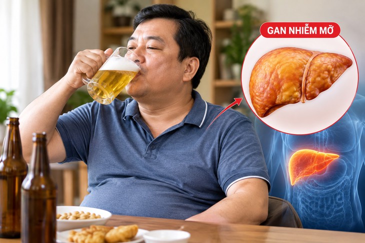 Gan nhiễm mỡ đang trẻ hóa, ai có nguy cơ?- Ảnh 1.