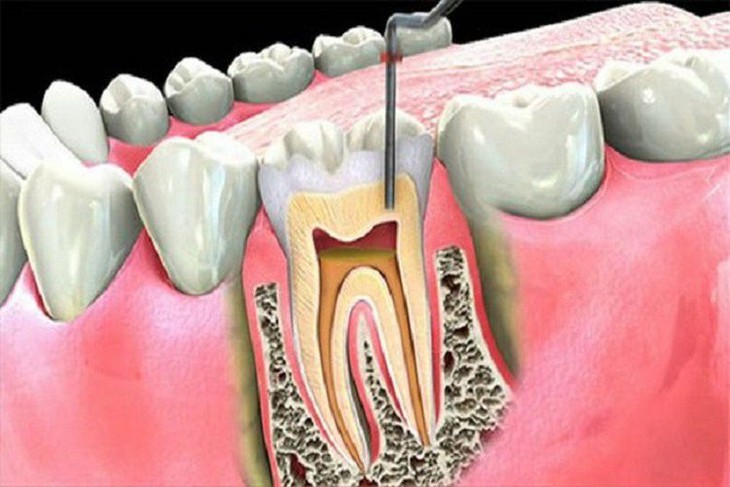 Viêm quanh răng gây hệ lụy gì?
- Ảnh 1.