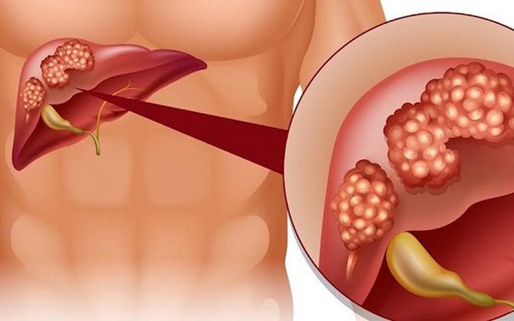 Lá gan sẽ 'mệt' thế nào nếu lạm dụng thực phẩm chức năng? - Ảnh 3.