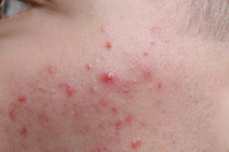 5 cách chăm sóc da và hạn chế trứng cá đỏ tái phát- Ảnh 1.
