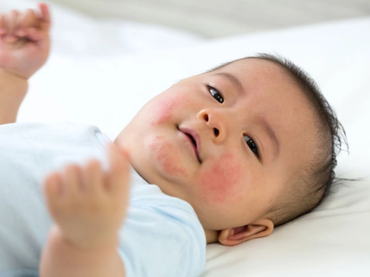 Làm sao biết con bạn bị dị ứng sữa?- Ảnh 1.