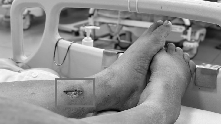Tái phát uốn ván nguy kịch vì mảnh tre 3cm 'giấu mình' dưới vết thương đã lành- Ảnh 2.