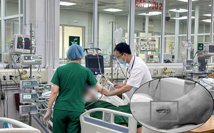 Phẫu thuật chuyển gân thành công cho bệnh nhân bị đứt gân duỗi ngón tay suốt 30 ngày - Ảnh 1.