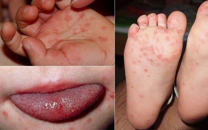 Khánh Hòa đã ghi nhận 3.688 ca tay chân miệng, bác sĩ khuyến cáo điều cần làm - Ảnh 1.