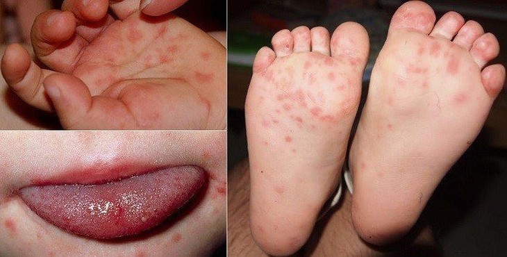 Tay chân miệng: Không phải trẻ nào mắc bệnh cũng nhẹ - Ảnh 1.