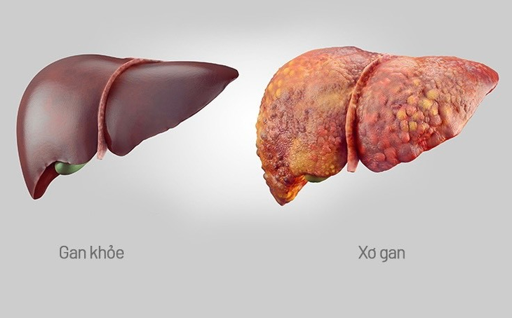 Lá gan sẽ “mệt” thế nào nếu lạm dụng thực phẩm chức năng? - Ảnh 2.