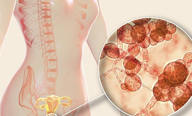 Mẹ bầu mắc nấm âm đạo nên uống thuốc hay đặt thuốc? - Ảnh 1.