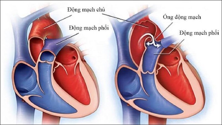 4 dấu hiệu bệnh tim bẩm sinh ở trẻ cha mẹ cần lưu ý- Ảnh 1.
