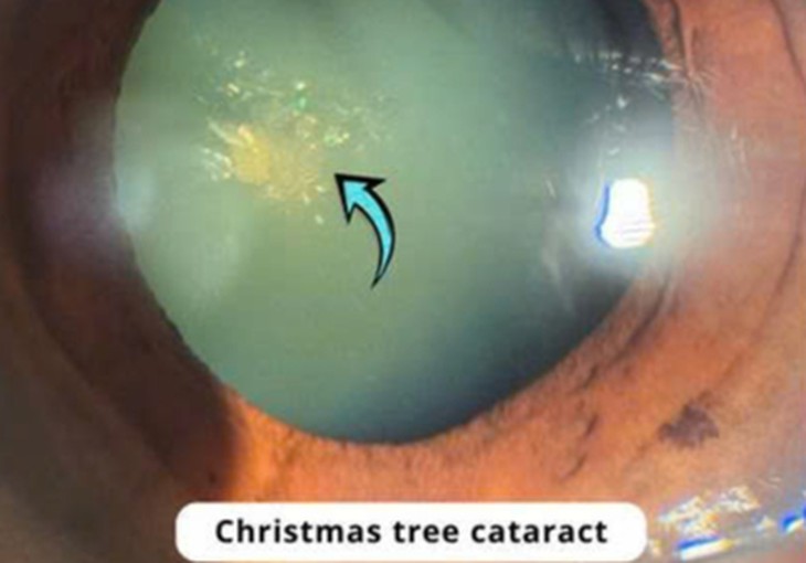 Phát hiện bệnh hiếm hình 'cây thông Noel' trong mắt người phụ nữ 70 tuổi- Ảnh 3.