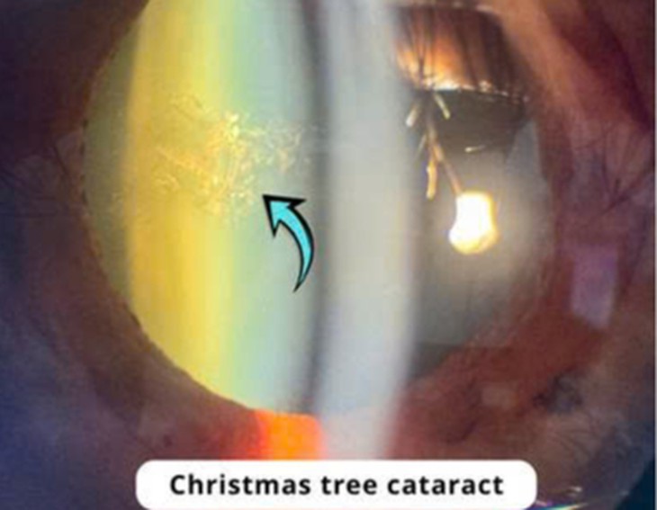 Phát hiện bệnh hiếm hình 'cây thông Noel' trong mắt người phụ nữ 70 tuổi- Ảnh 2.