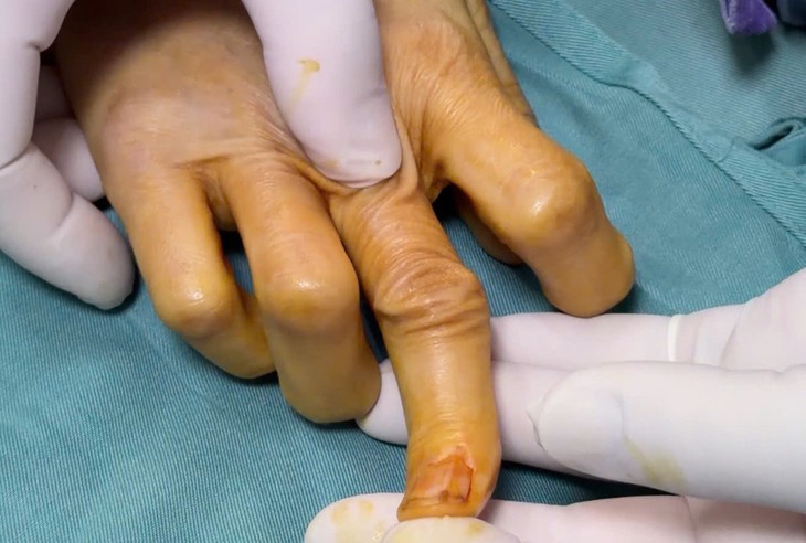 Phẫu thuật chuyển gân thành công cho bệnh nhân bị đứt gân duỗi ngón tay suốt 30 ngày - Ảnh 1.