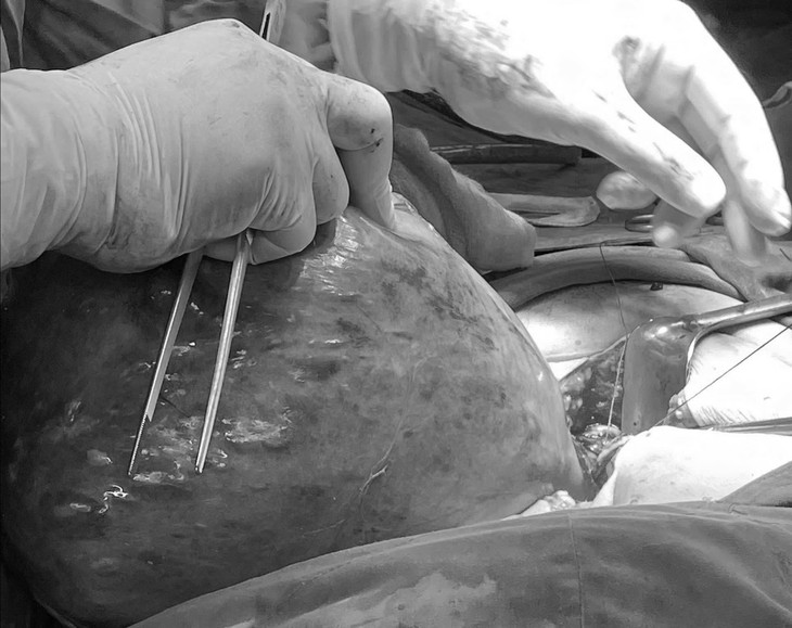 5 năm không điều trị u xơ tử cung, người phụ nữ mang khối u nặng 4,5kg - Ảnh 2.