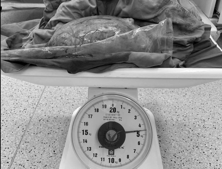 5 năm không điều trị u xơ tử cung, người phụ nữ mang khối u nặng 4,5kg - Ảnh 3.