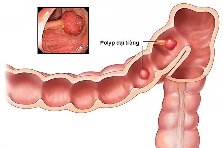 Polyp đại tràng được chẩn đoán như thế nào?- Ảnh 1.
