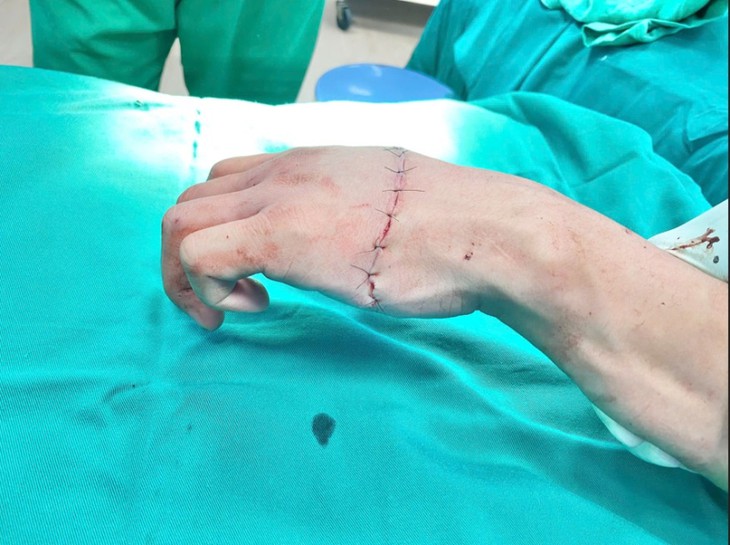 Vi phẫu cứu bàn tay gần đứt lìa cho nam thanh niên 21 tuổi- Ảnh 2.