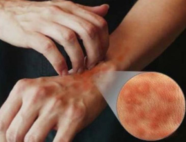Ngứa, dùng thuốc thế nào cho hiệu quả? 1