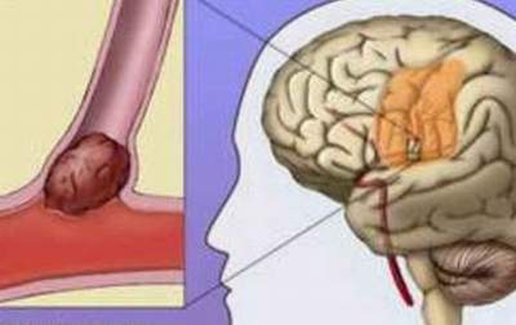 Cách chăm sóc người bị tai biến mạch máu não 1