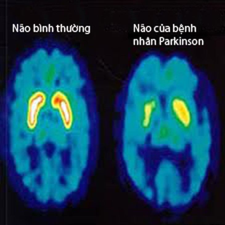 Cách chăm sóc bệnh nhân Parkinson 1