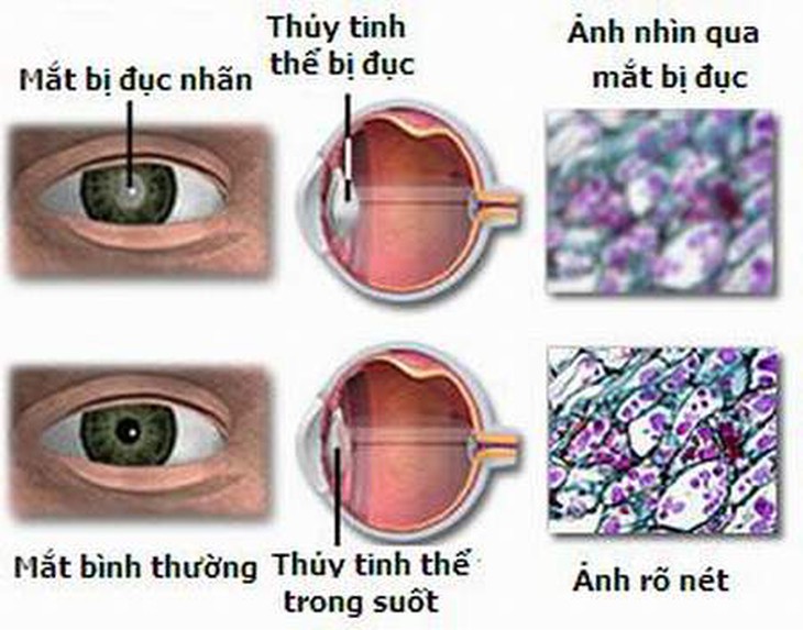 Trẻ em cũng có thể bị đục thể thủy tinh? 1