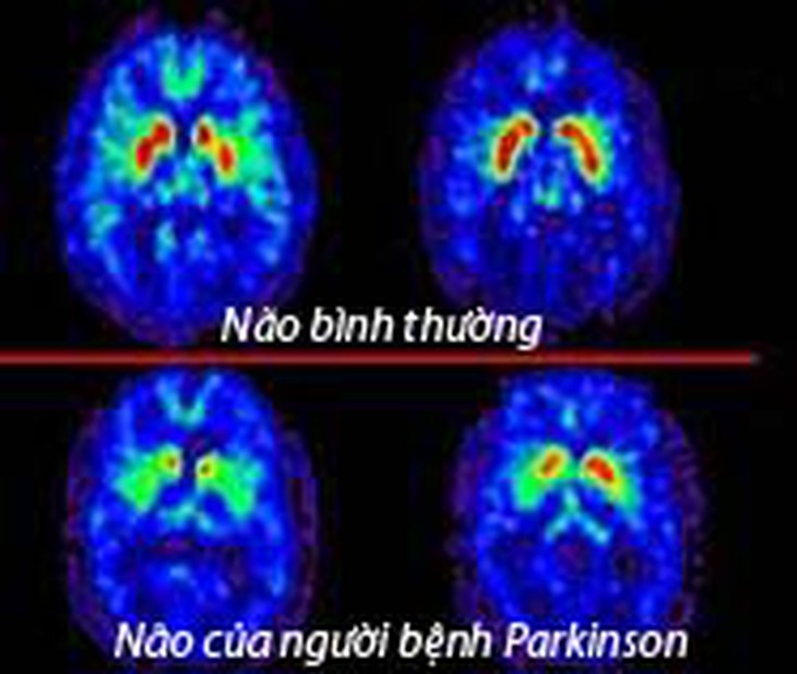 Parkinson Bệnh của người cao tuổi 2