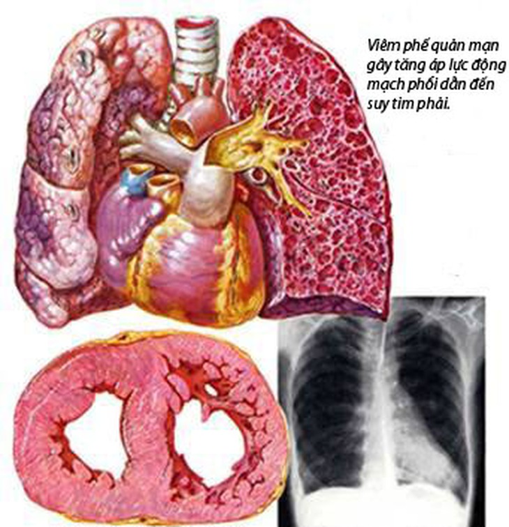 Phòng bệnh tâm phế mạn ở người cao tuổi 1