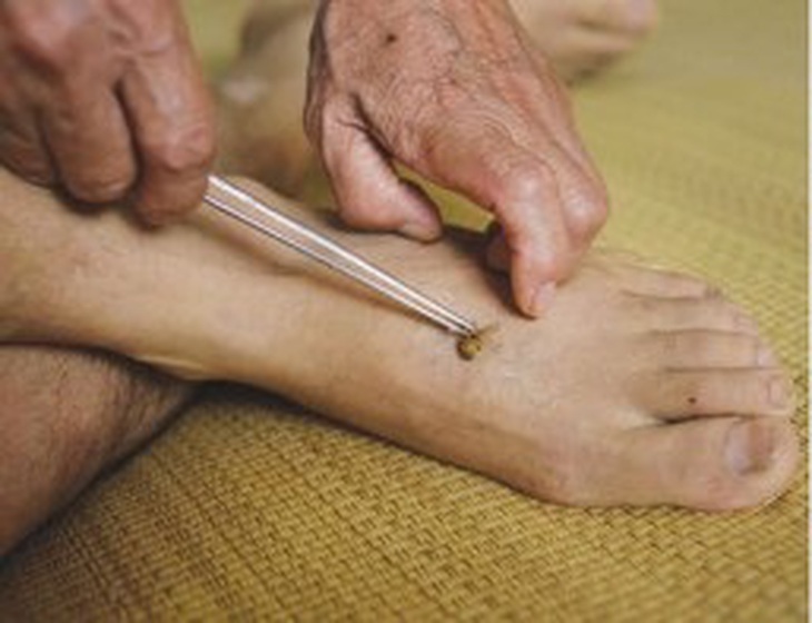Xử trí dị ứng do ong đốt 1