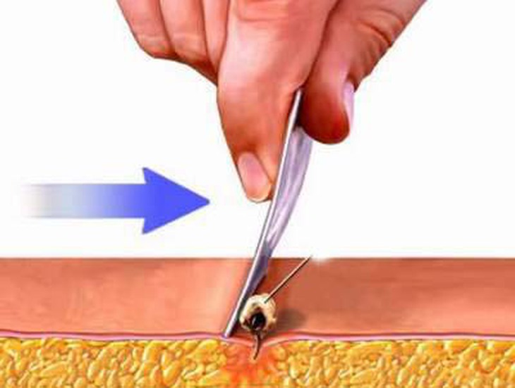 Xử trí dị ứng do ong đốt 2