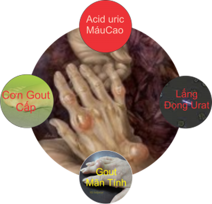 Ăn uống để phòng bệnh gút 2