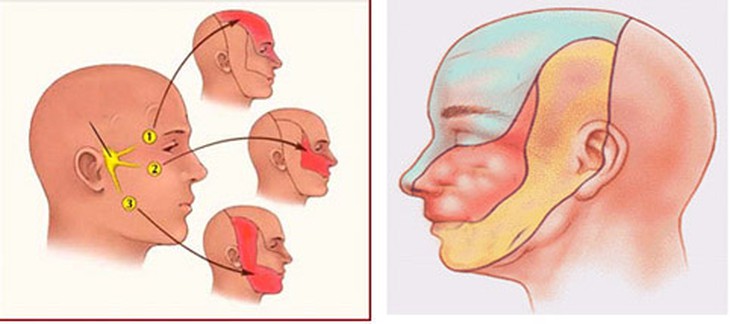 Ðau dây thần kinh số V và thuốc trị 1