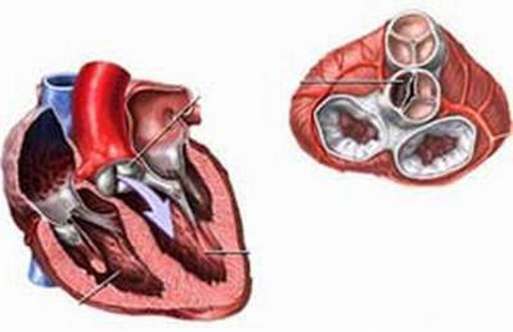 Bệnh thấp tim - Làm sao biết và tránh?   1